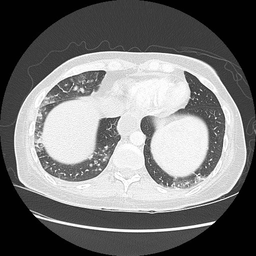 Aspiration pneumonia secondary to laparoscopic banding (Radiopaedia 18345-18183 lung window 90).jpg