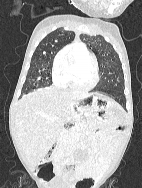 Asplenia syndrome (Radiopaedia 73083-83792 Coronal lung window 39).jpg