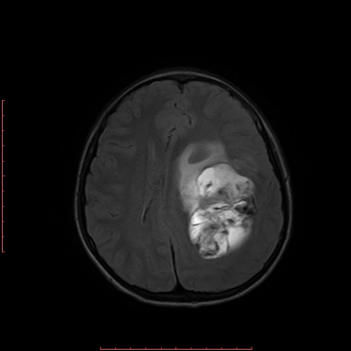 File:Astroblastoma (Radiopaedia 74287-85162 Axial FLAIR 14).jpg