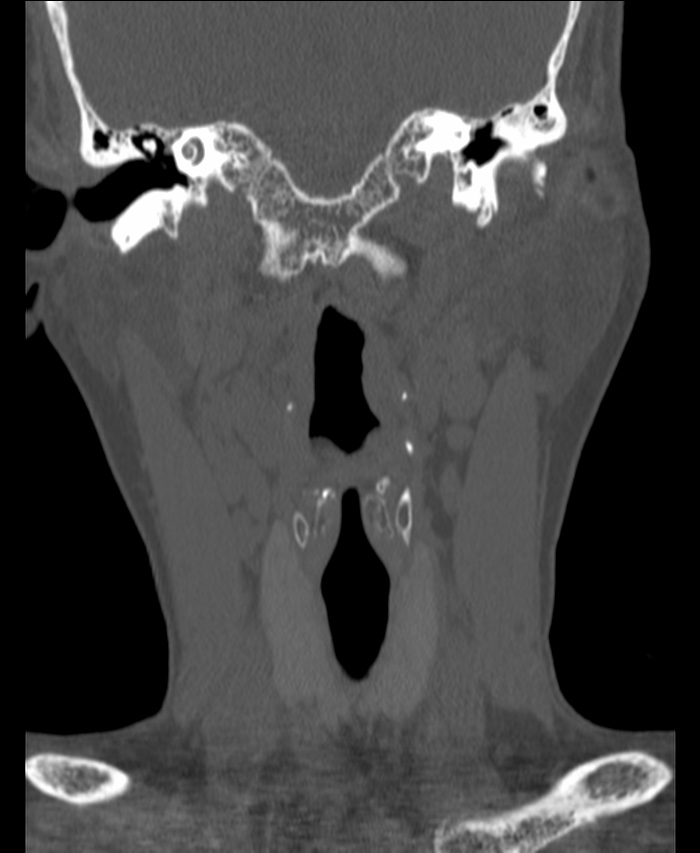 Atlanto-occipital assimilation with basilar invagination (Radiopaedia 70122-80188 Coronal bone window 37).jpg