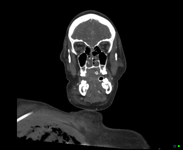 Atlanto-occipital dissociation - Traynelis type 1 (Radiopaedia 87570-103949 B 10).jpg