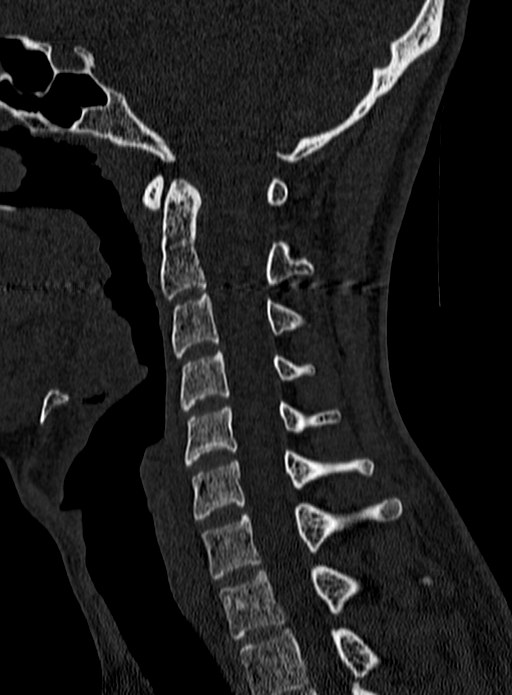 Atlantoaxial subluxation (Radiopaedia 44681-48450 Sagittal bone window 70).jpg