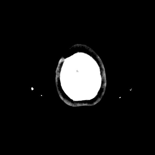 Atretic cephalocele (Radiopaedia 89782-106881 Axial non-contrast 185).jpg