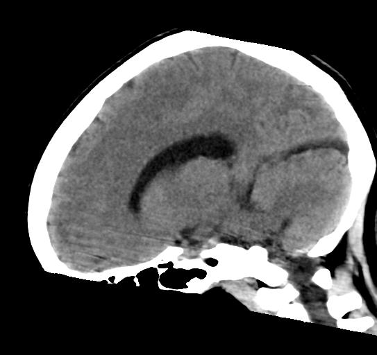 File:Atretic encephalocoele with inferior vermis hypoplasia (Radiopaedia 30443-31107 C 13).jpg
