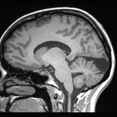 Atretic encephalocoele with inferior vermis hypoplasia (Radiopaedia 30443-31108 Sagittal T1 74).jpg
