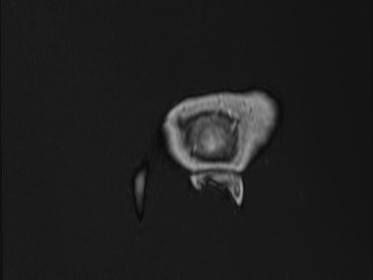 Atypical meningioma (Radiopaedia 62985-71406 Sagittal T1 C+ 108).jpg