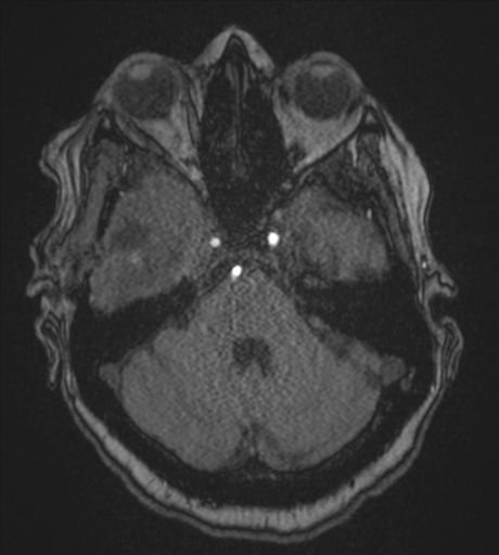 Atypical meningioma (WHO Grade II) (Radiopaedia 54742-60981 Axial MRA 27).png