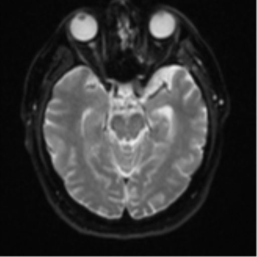 Atypical meningioma (WHO grade II) with brain invasion (Radiopaedia 57767-64729 Axial DWI 11).png