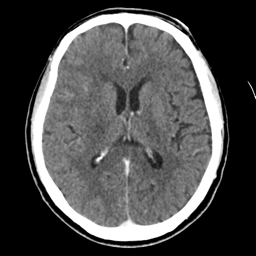 Atypical meningioma (WHO grade II) with osseous invasion (Radiopaedia 53654-59715 Axial C+ delayed 30).png