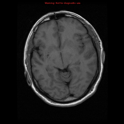 File:Atypical meningioma - grade II (Radiopaedia 13303-13305 Axial T1 10).jpg