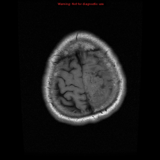 File:Atypical meningioma - grade II (Radiopaedia 13303-13305 Axial T1 20).jpg