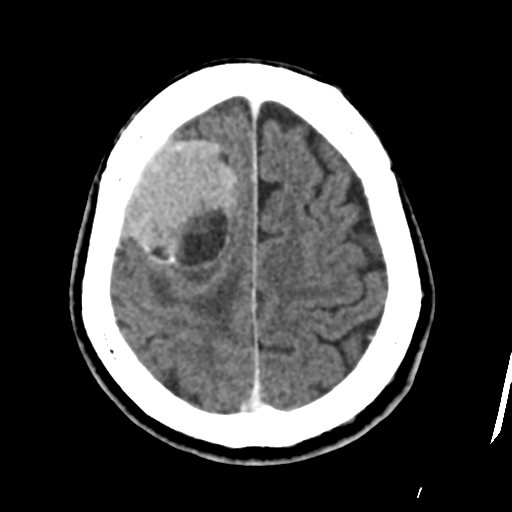 Atypical meningioma with skull invasion (Radiopaedia 34357-35649 Axial C+ delayed 42).png