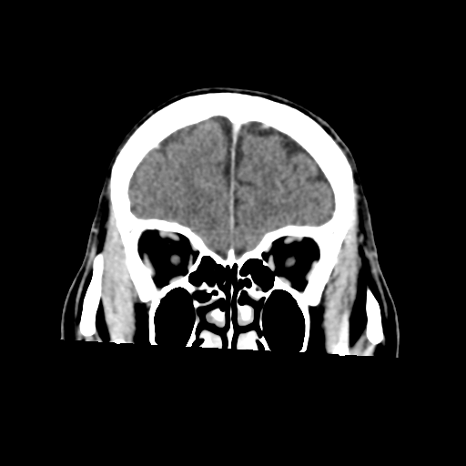 Atypical meningioma with skull invasion (Radiopaedia 34357-35649 Coronal C+ delayed 14).png