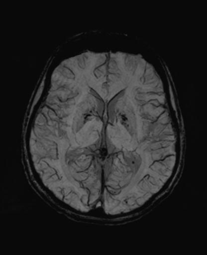 Autoimmune limbic encephalitis (Radiopaedia 30363-31005 SWI - mIP 37).jpg
