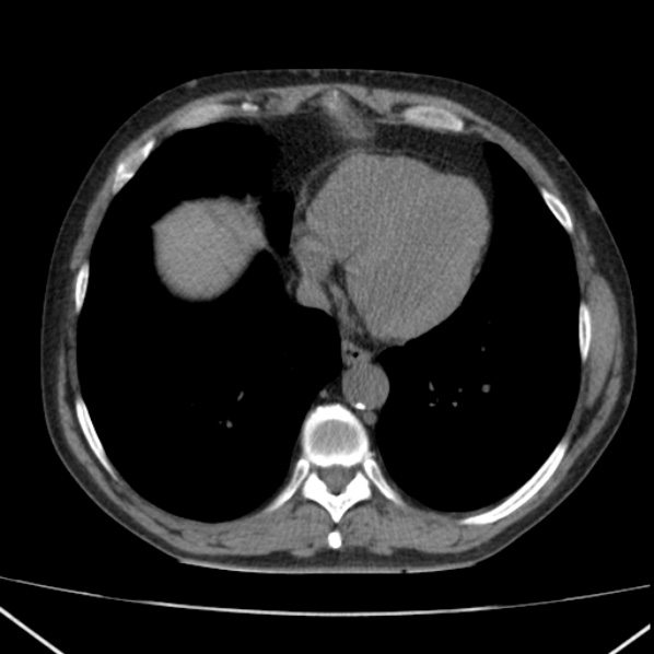 File:Autosomal dominant polycystic kidney disease (Radiopaedia 36539-38101 Axial non-contrast 4).jpg