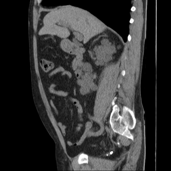 File:Autosomal dominant polycystic kidney disease (Radiopaedia 36539-38101 D 34).jpg