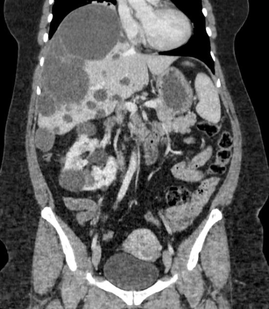 Autosomal dominant polycystic kidney disease (Radiopaedia 57124-64017 B 36).jpg