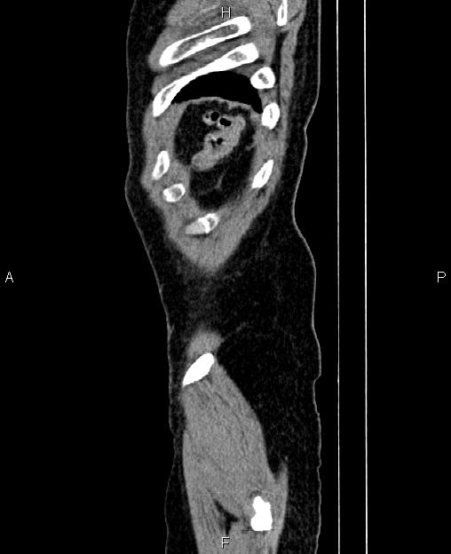 Autosomal dominant polycystic kidney disease (Radiopaedia 87830-104287 C 91).jpg