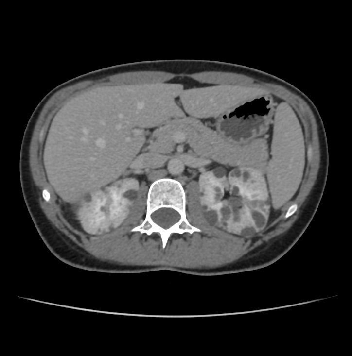 Autosomal dominant polycystic kidney disease - early onset (Radiopaedia 40734-43387 A 21).jpg