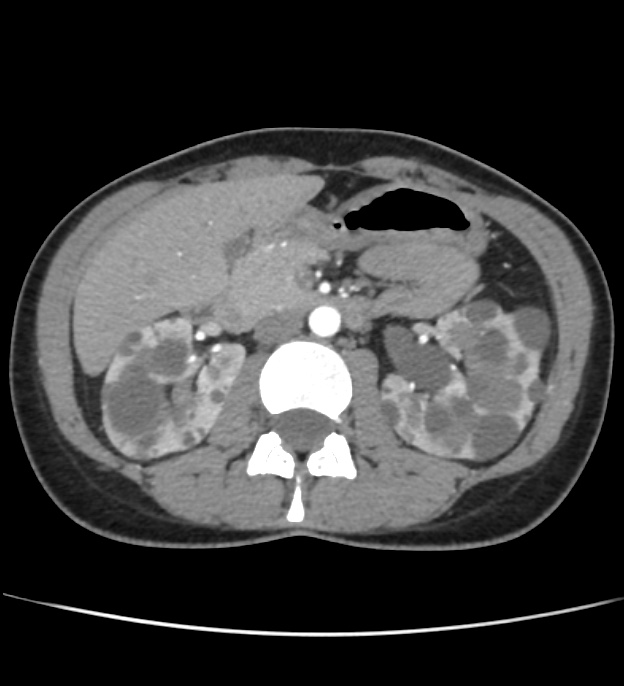 Autosomal dominant polycystic kidney disease - early onset (Radiopaedia 40734-43387 B 23).jpg