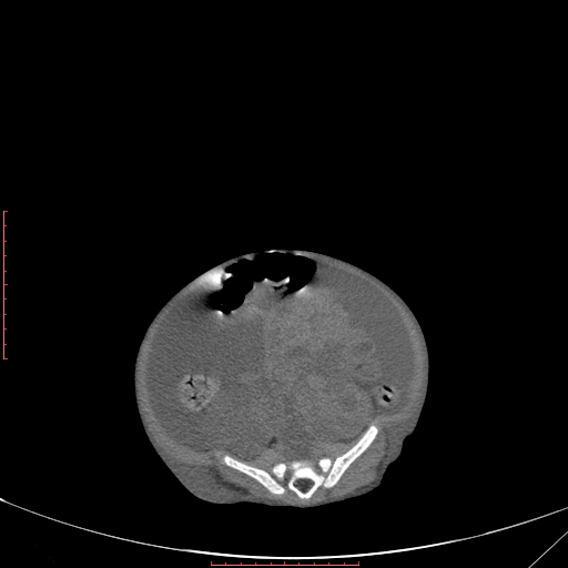 Autosomal recessive polycystic kidney disease associated with Caroli disease (Radiopaedia 61932-69984 Axial non-contrast 282).jpg