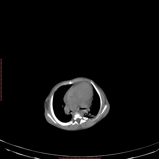 File:Autosomal recessive polycystic kidney disease associated with Caroli disease (Radiopaedia 61932-69984 Axial non-contrast 54).jpg