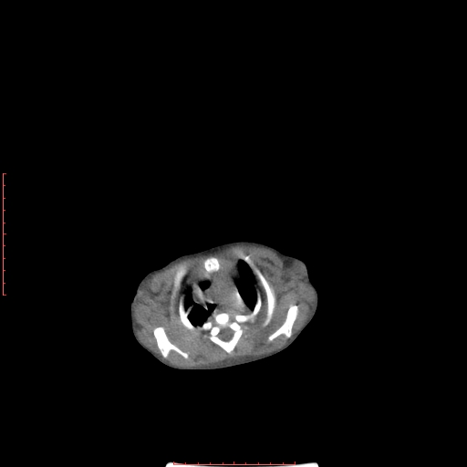 Autosomal recessive polycystic kidney disease associated with Caroli disease (Radiopaedia 61932-69984 B 19).jpg