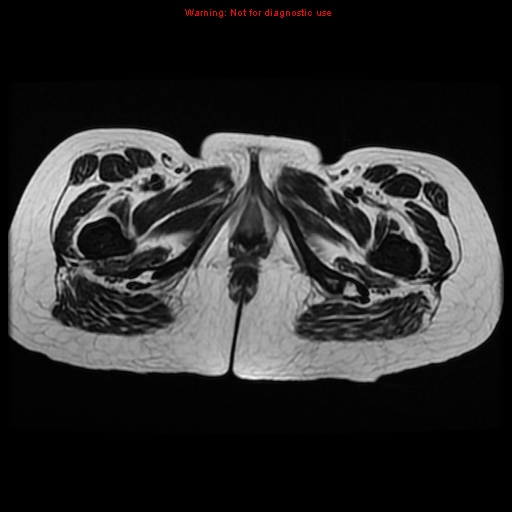 File:Avascular necrosis in sickle cell disease (Radiopaedia 17448-17151 Axial T2 18).jpg