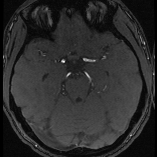 Azygos anterior cerebral artery (Radiopaedia 17059-16756 Axial MRA 45).jpg
