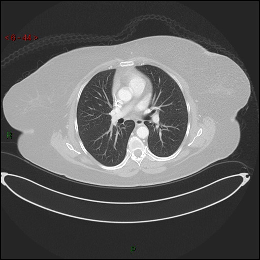 File:Azygos fissure and lobe (Radiopaedia 47620-52278 Axial lung window 44).jpg