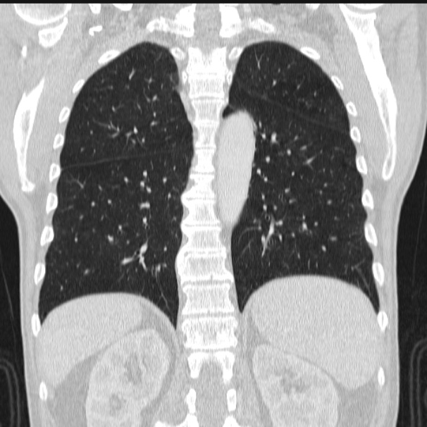 Azygos lobe (Radiopaedia 38259-40275 Coronal lung window 57).jpg