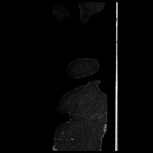 B-cell lymphoma of the mesentery (Radiopaedia 65711-74827 C 16).jpg