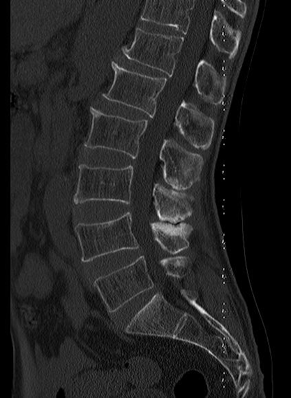File:Baastrup syndrome (Radiopaedia 64891-73838 Sagittal bone window 11).jpg