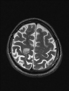 File:Balo concentric sclerosis (Radiopaedia 50458-55940 Axial T2 8).jpg