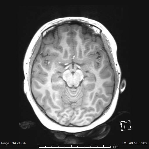 Balo concentric sclerosis (Radiopaedia 61637-69636 Axial T1 34).jpg