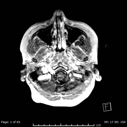Balo concentric sclerosis (Radiopaedia 61637-69636 Axial T1 C+ 1).jpg