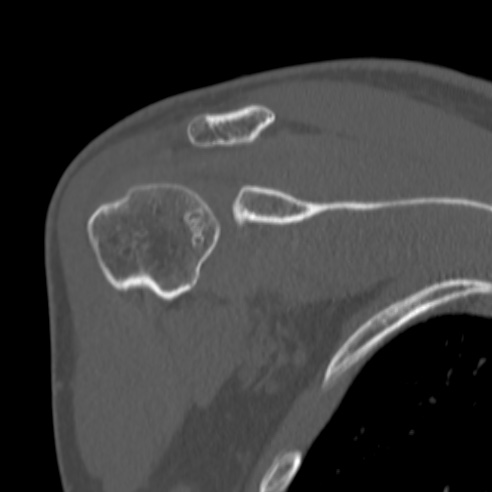 Bankart lesion (Radiopaedia 57256-64185 Coronal bone window 19).jpg