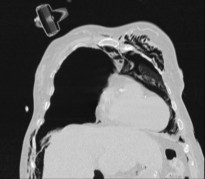 Barotrauma due to mechanical ventilation (Radiopaedia 28079-28336 Coronal lung window 28).jpg