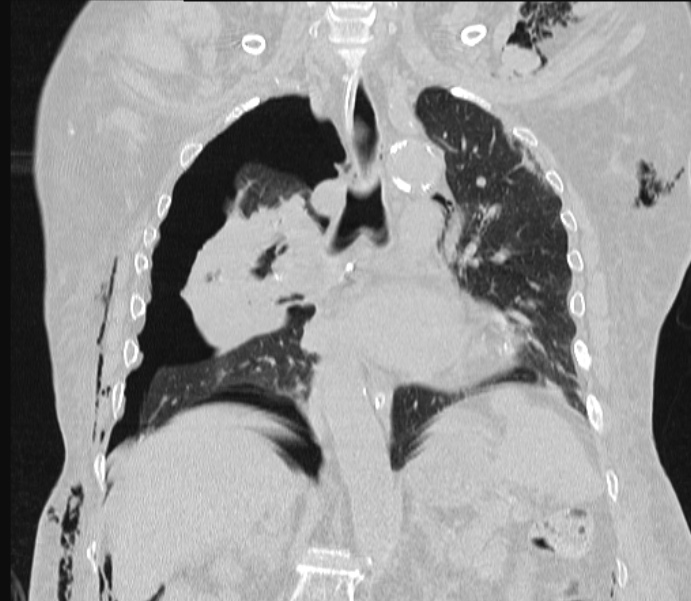 Barotrauma due to mechanical ventilation (Radiopaedia 28079-28336 Coronal lung window 55).jpg