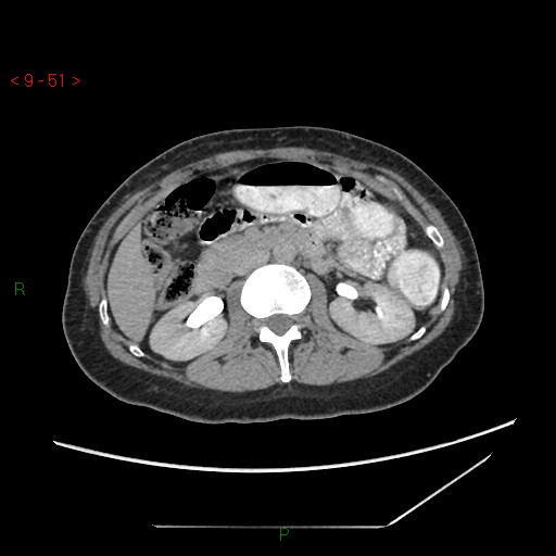 File:Bartholin gland cyst (Radiopaedia 54904-61181 Axial C+ delayed 13).jpg