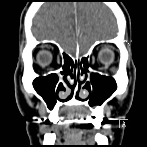 File:Basal cell carcinoma (periocular with orbital invasion) (Radiopaedia 30974-31672 Coronal Postcontrast 15).jpg