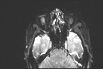 File:Basal cell carcinoma - nasal region (Radiopaedia 70292-80365 Axial DWI 8).jpg