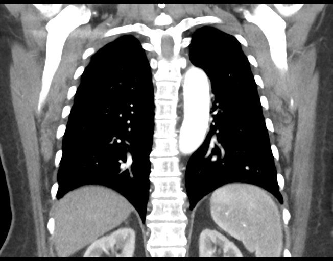 Basal ganglia metastasis (Radiopaedia 78928-91832 C 37).png