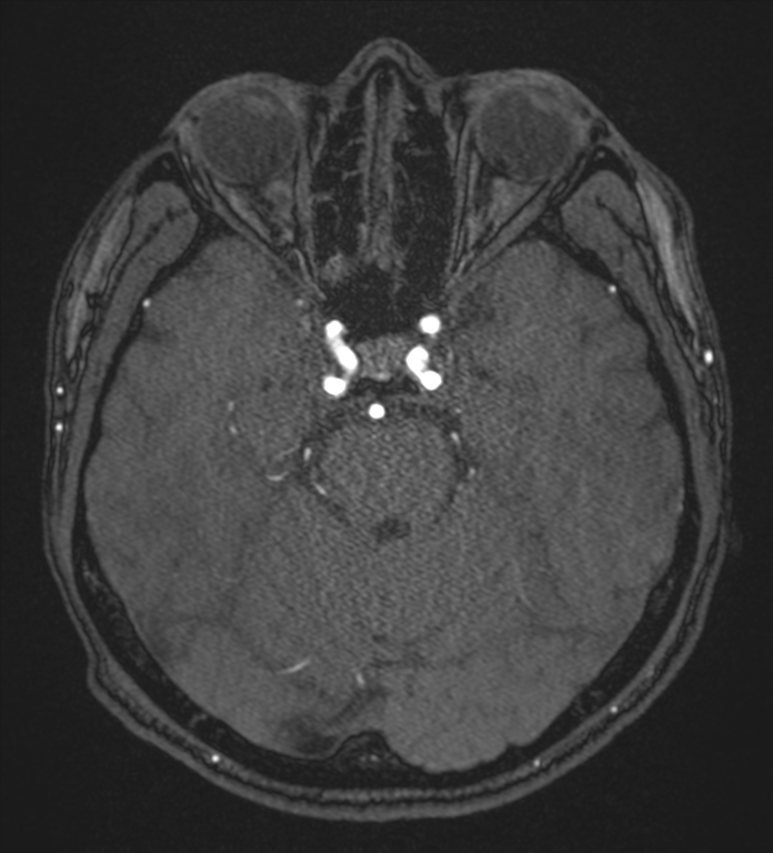 Basal ganglia subacute infarct (Radiopaedia 80201-93521 Axial MRA 37).png
