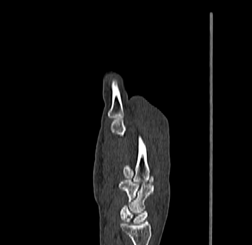 Base of 2nd metacarpal fracture (Radiopaedia 73741-84544 Sagittal bone window 39).jpg
