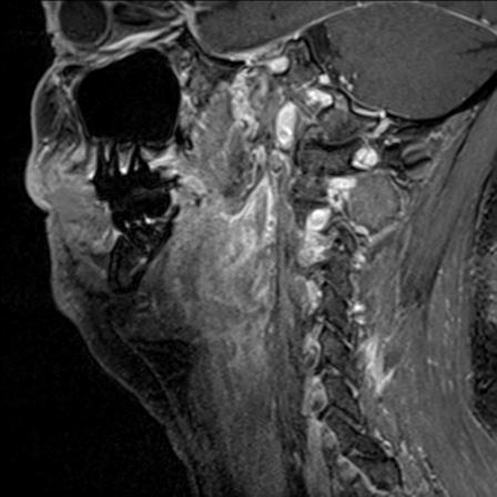 File:Base of tongue squamous cell carcinoma (Radiopaedia 31174-31884 F 59).jpg