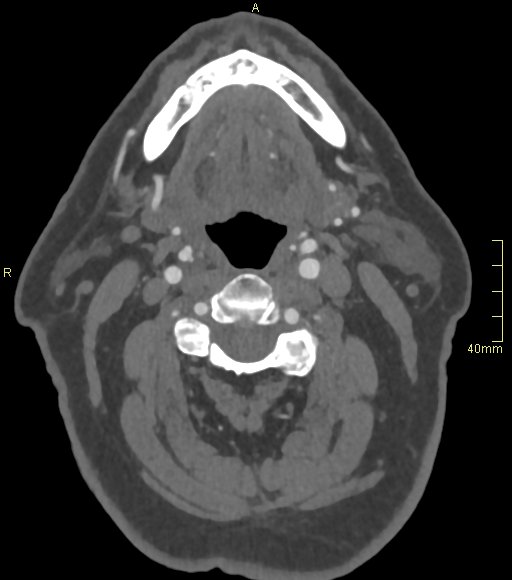 Basilar artery aneurysm (Radiopaedia 56261-62932 A 7).jpg