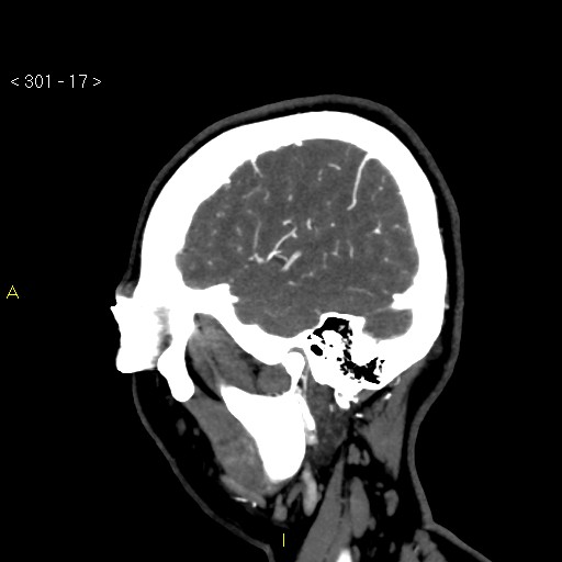 File:Basilar artery thrombosis (Radiopaedia 16260-15944 C 11).jpg