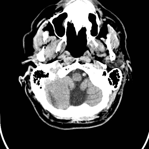 File:Basilar artery thrombosis (Radiopaedia 26986-27162 Axial non-contrast 4).jpg