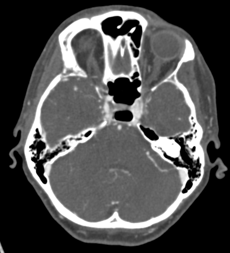 Basilar tip aneurysm with coiling (Radiopaedia 53912-60086 A 45).jpg